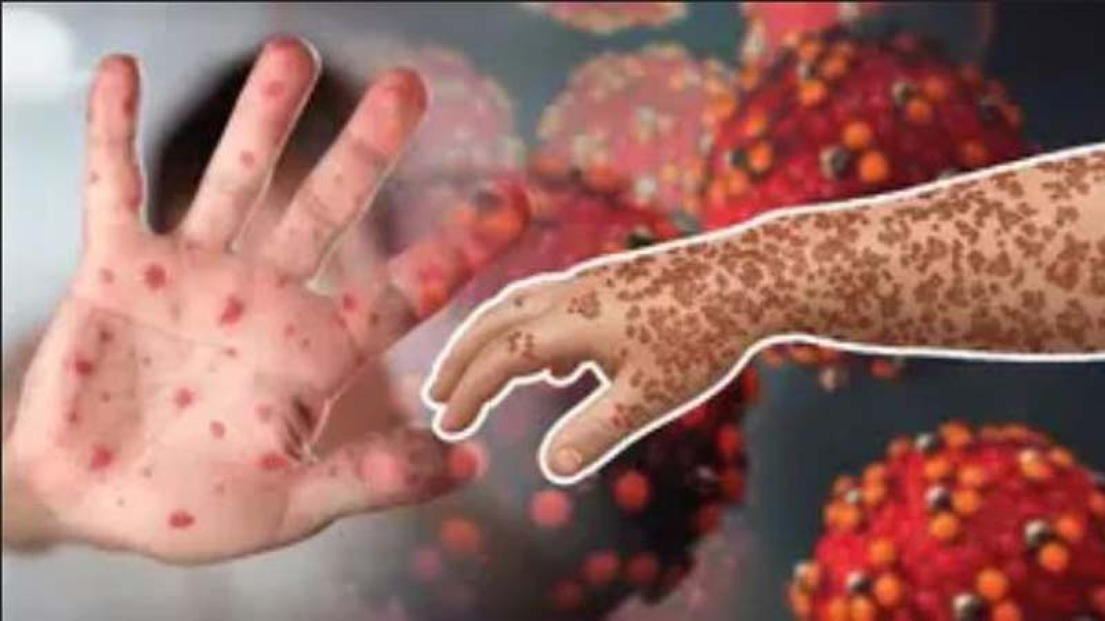 খুলনা বিভাগে ৯৫৬ সন্দেহজনক হাম রোগী শনাক্ত, মৃত্যু ৭