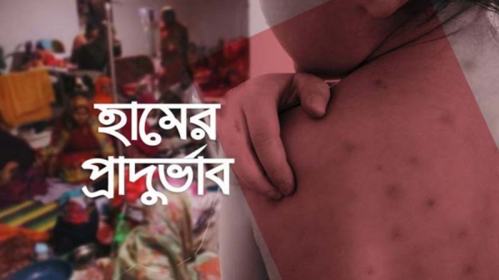 হাম সন্দেহে নিভে গেলো আরও ৮ শিশুর প্রাণ