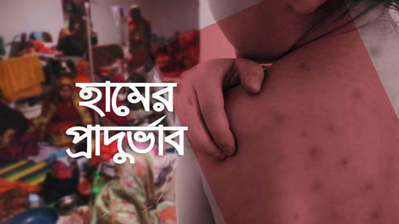 ইদের দিনে হাম কেড়ে নিলো আরও ৫ প্রাণ