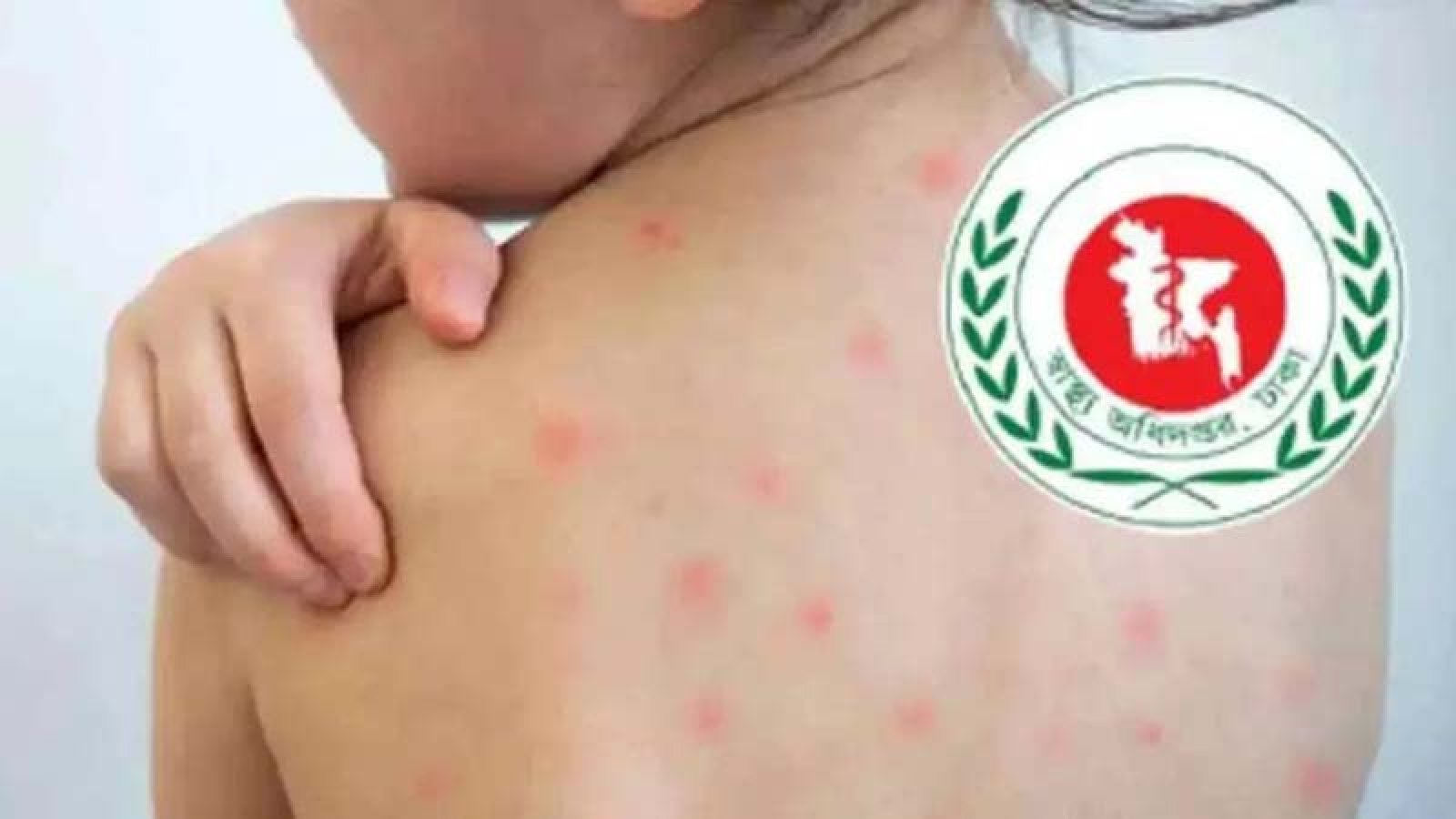 হামের উপসর্গ নিয়ে প্রাণ গেল আরও ৫ শিশুর