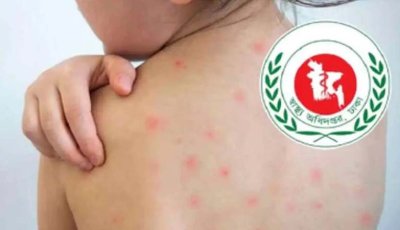 হাম উপসর্গে আরও ৪ শিশুর মৃত্যু, আক্রান্ত ১১৪৫