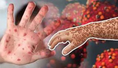 রাজশাহীতে হামের উপসর্গে উদ্বেগ, এক দিনে ৩ শিশুর মৃত্যু