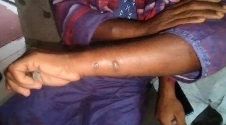 গাইবান্ধায় রোগাক্রান্ত॥ গরু কাটাকাটি করা ১১ জনের দেহে ‘অ্যানথ্রাক্স উপসর্গ’